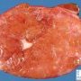 Focal nodular hyperplasia