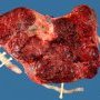 Triple pregnancy placenta