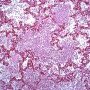 Acute pneumonia in bacterial pneumonia