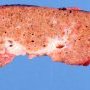 Micronodular cirrhosis in Wilson disease