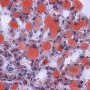 Macrovesicular hepatocytic steatosis (Oil-Red-O)