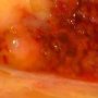Hodgkin lymphoma invasion of the liver