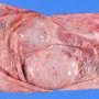 Ovarian cystic juvenile granulosa tumor