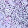 Gastric acute glandulitis