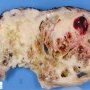 Malignant peripheral nerve sheath tumor in NF1 (neurofibrosarcoma)