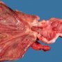 Crohn ileitis (Ileal Crohn disease)