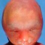 Bilateral cleft lip/palate in trisomy 13