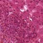 Acute cholangitis