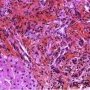 Portal fibrosis and biliary ductular proliferation in juvenile (...)