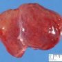 Fetal neonatal hemochromatosis