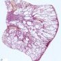 ARPKD at 34 weeks