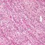 Mesenchymal component with muscular differentiation
