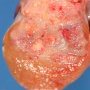 Testicular embryonal carcinoma