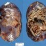 Intrapulmonary bronchogenic cyst