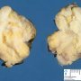 Lipblastoma