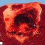 Splenic infarct