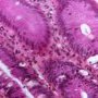 Colonic GVHD