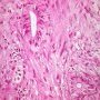 Colonic localization of an infantile myofibromatosis