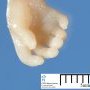 Posta-axial hexadactyly in a Meckel syndrome
