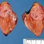 Small hepatoblastoma
