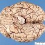Normal brain