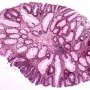 Tubulous microadenoma in FAP