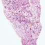 BALT hyperplasia (HPS)