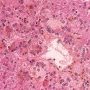 Centrilobular cholestasis