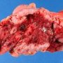 Crohn ileitis and colitis (ileocaecal region)