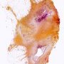 Peritoneal endometriotic nodule (endometriosis)