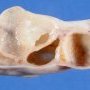 Ovarian cystic juvenile granulosa tumor