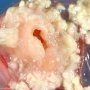 Ovarian dermoid cyst
