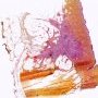 Plexiform fibrohistiocytic tumor