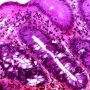 Colonic GVHD