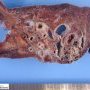 Pulmonary arteriovenous malformation in Hereditary hemorrhagic (...)