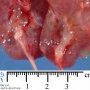 Cortical cysts under the renal capsula