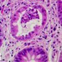 Cryptic abcess in colonic Crohn disease