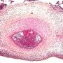 Acute chorioamnionitis