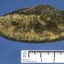 Micronodular cirrhosis in extrahepatic biliary tract atresia