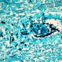 Fetal candida pneumonitis