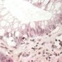 Inflammatory apoptotic cells in chronic colitis