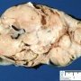 Intra-abdominal immature teratoma