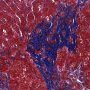 Portal fibrosis and biliary ductular proliferation in juvenile (...)