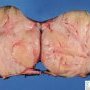 Mammary fibroadenoma