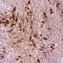 Bone marrow localization of classic Hodgkin lymphoma (CD30)