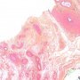 Spermatic cord torsion
