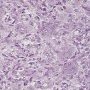 Metaphyseal fibrous defect - Microscopy (Elsevier)