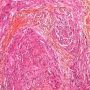 Epithelioid sarcoma