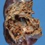 Intrapulmonary bronchogenic cyst