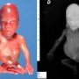 Caudal regression syndrome with lombosacral agenesis
